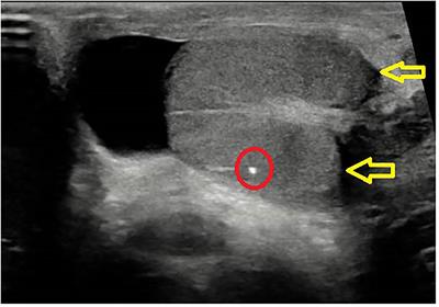 Burned-Out Testicular Tumors in Adolescents: Clinical Aspects and Outcome